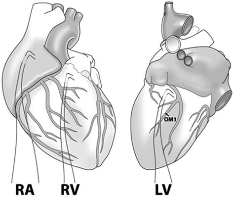 epicardial lead placement surgery.